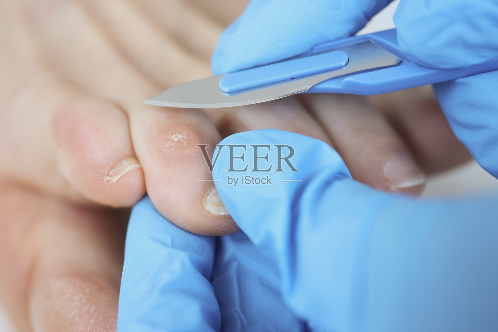 外科医生戴着橡胶手套，用解剖刀去除脚趾上的干痂照片摄影图片