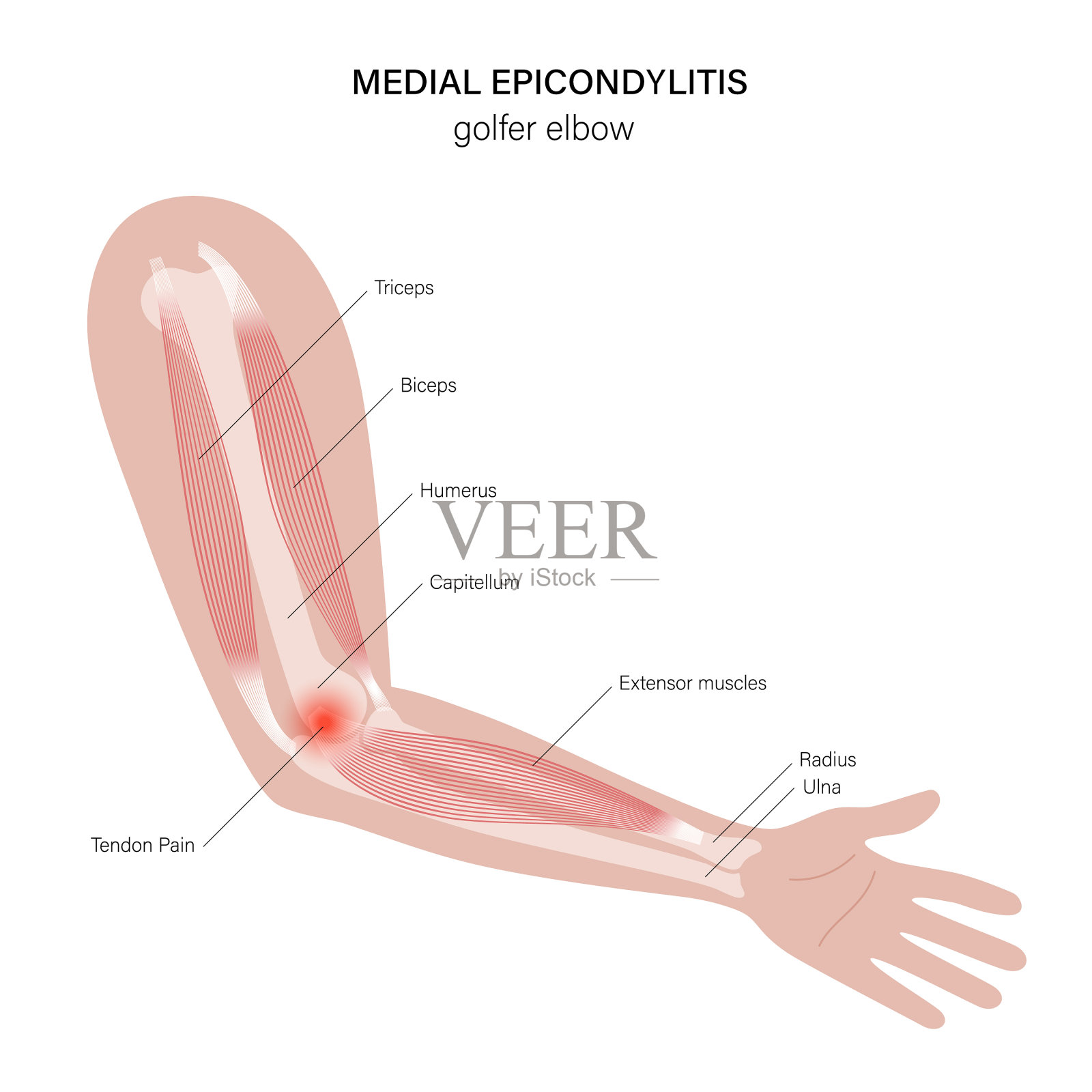 内上髁炎高尔夫肘插画图片素材