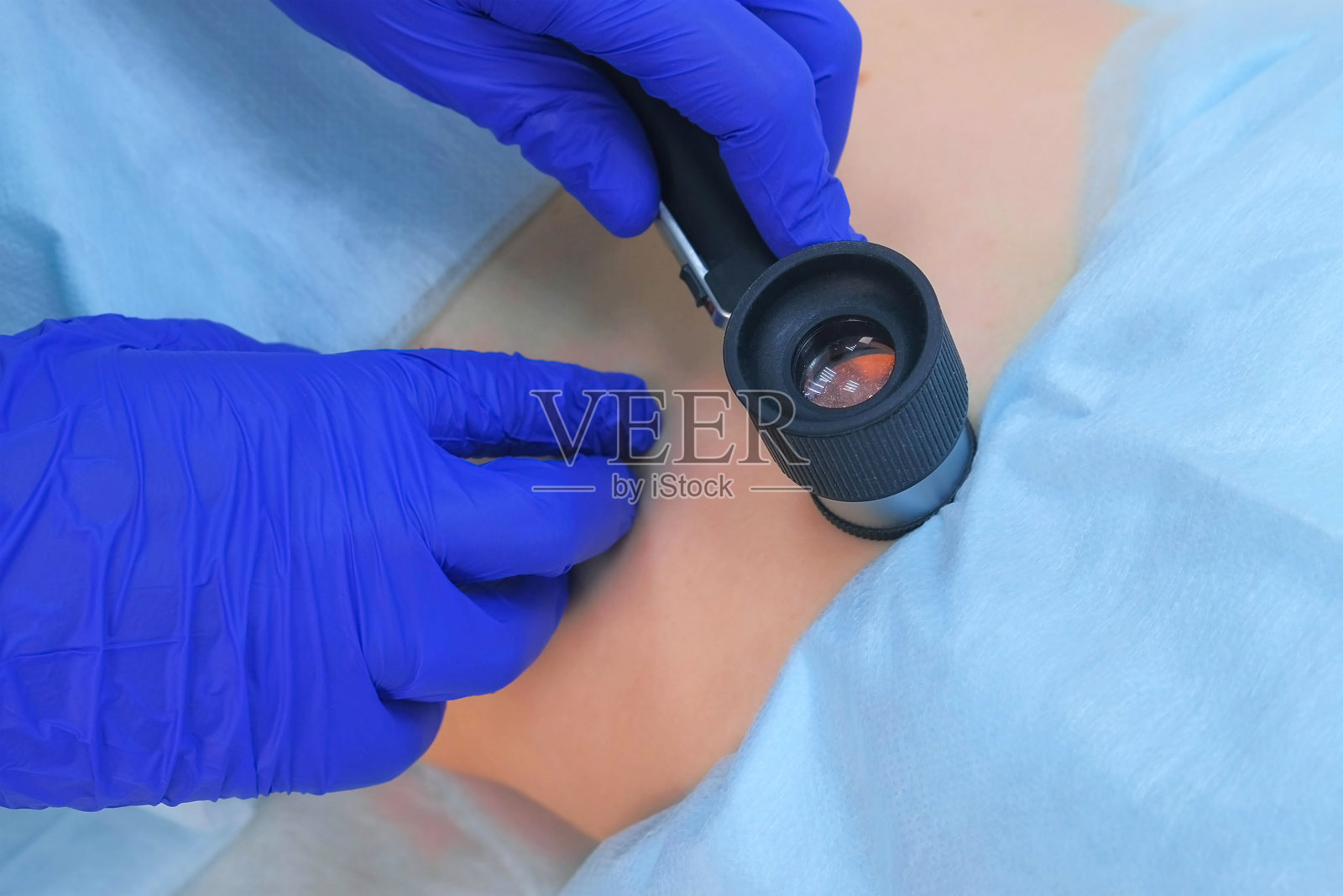 医生检查痣前使用皮肤镜放大镜摘除，近距离观察。照片摄影图片