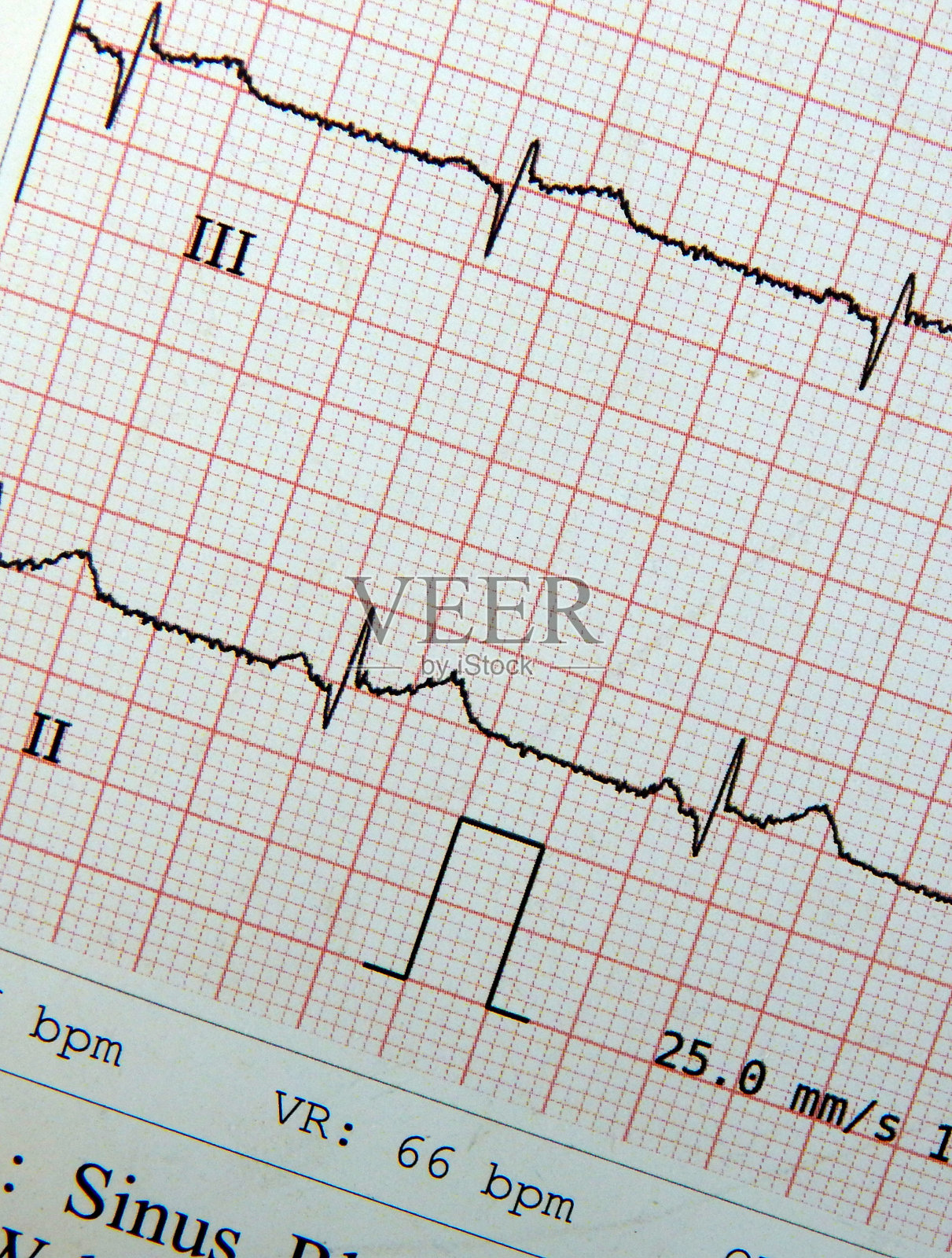 在医院的心电图输出或脉搏波测量设备的打印输出照片摄影图片