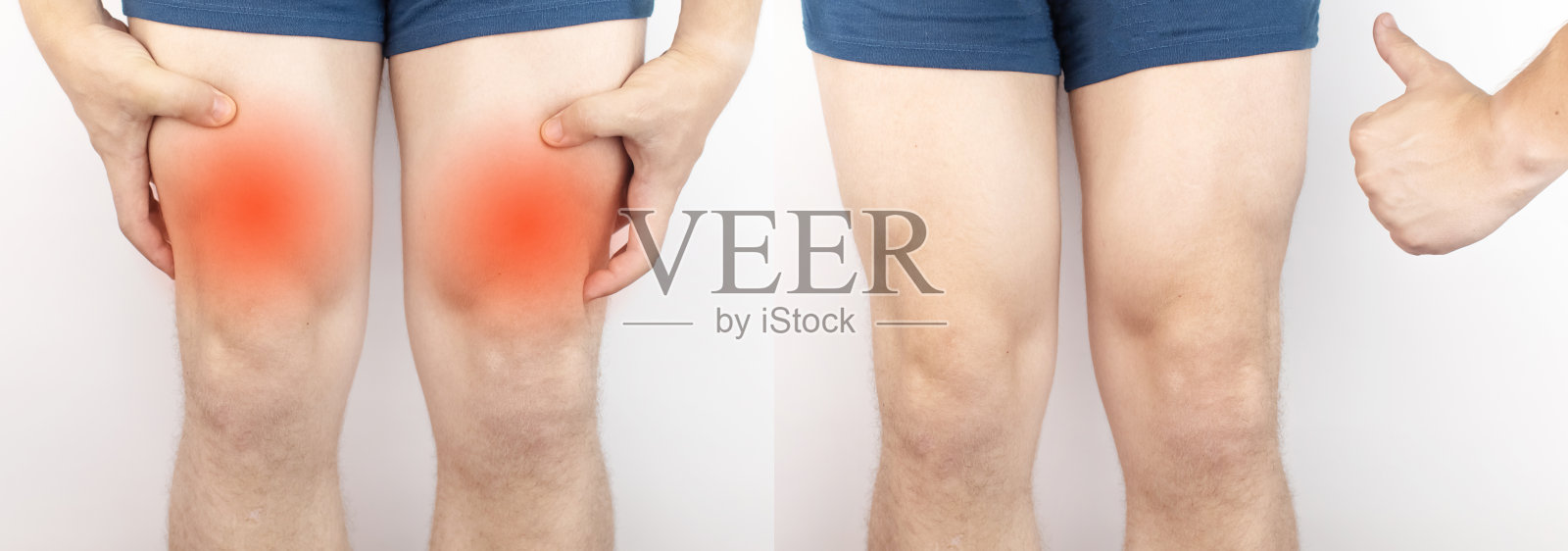 之前和之后。在左边，一名男子在肌肉拉伤或撕裂后，臀部剧烈疼痛。在右边，医生已经治愈了，大腿的肌肉也不再受到干扰。骨折照片摄影图片