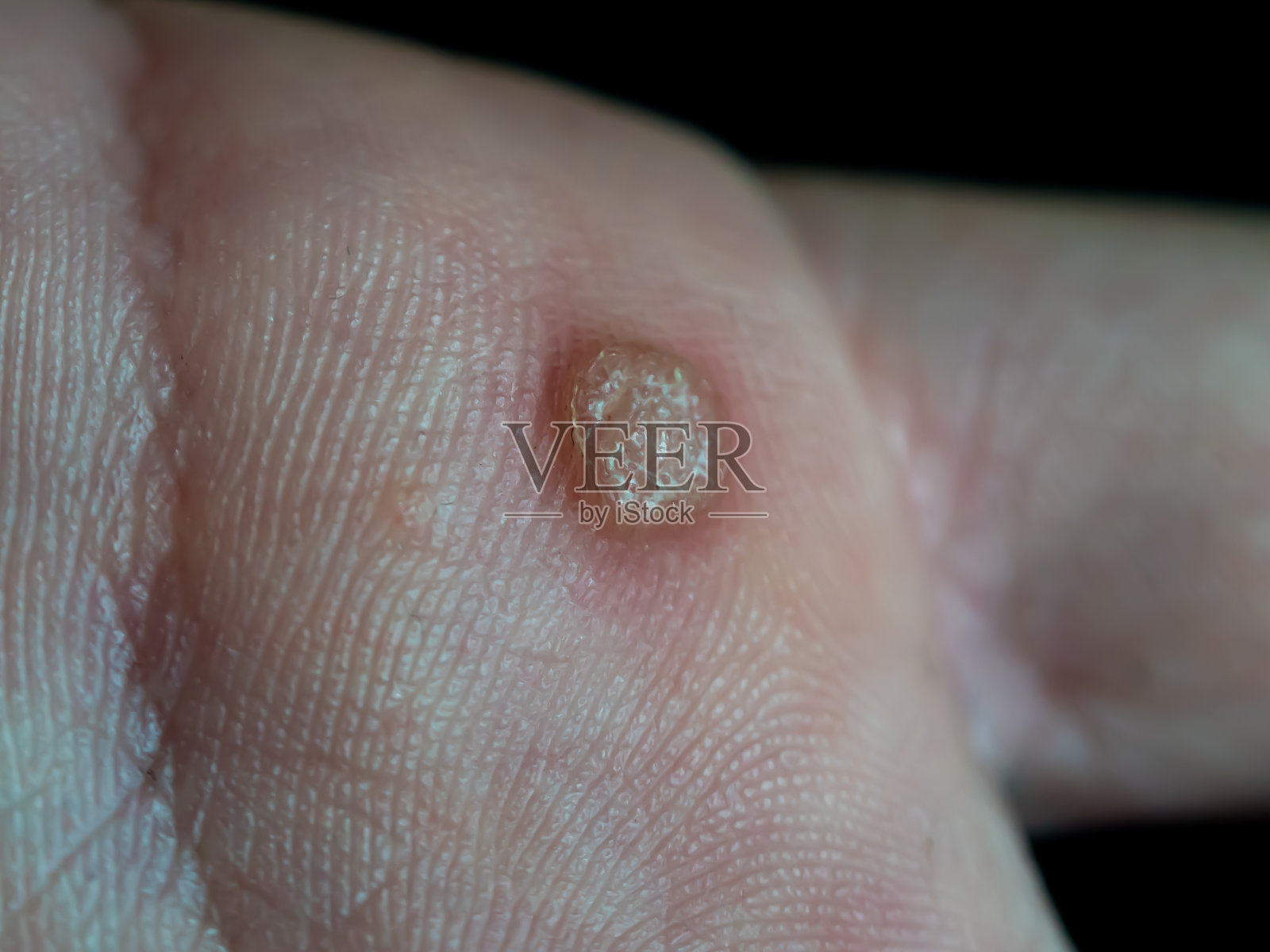 手上的大疣。孤立的黑色与浅景深。照片摄影图片