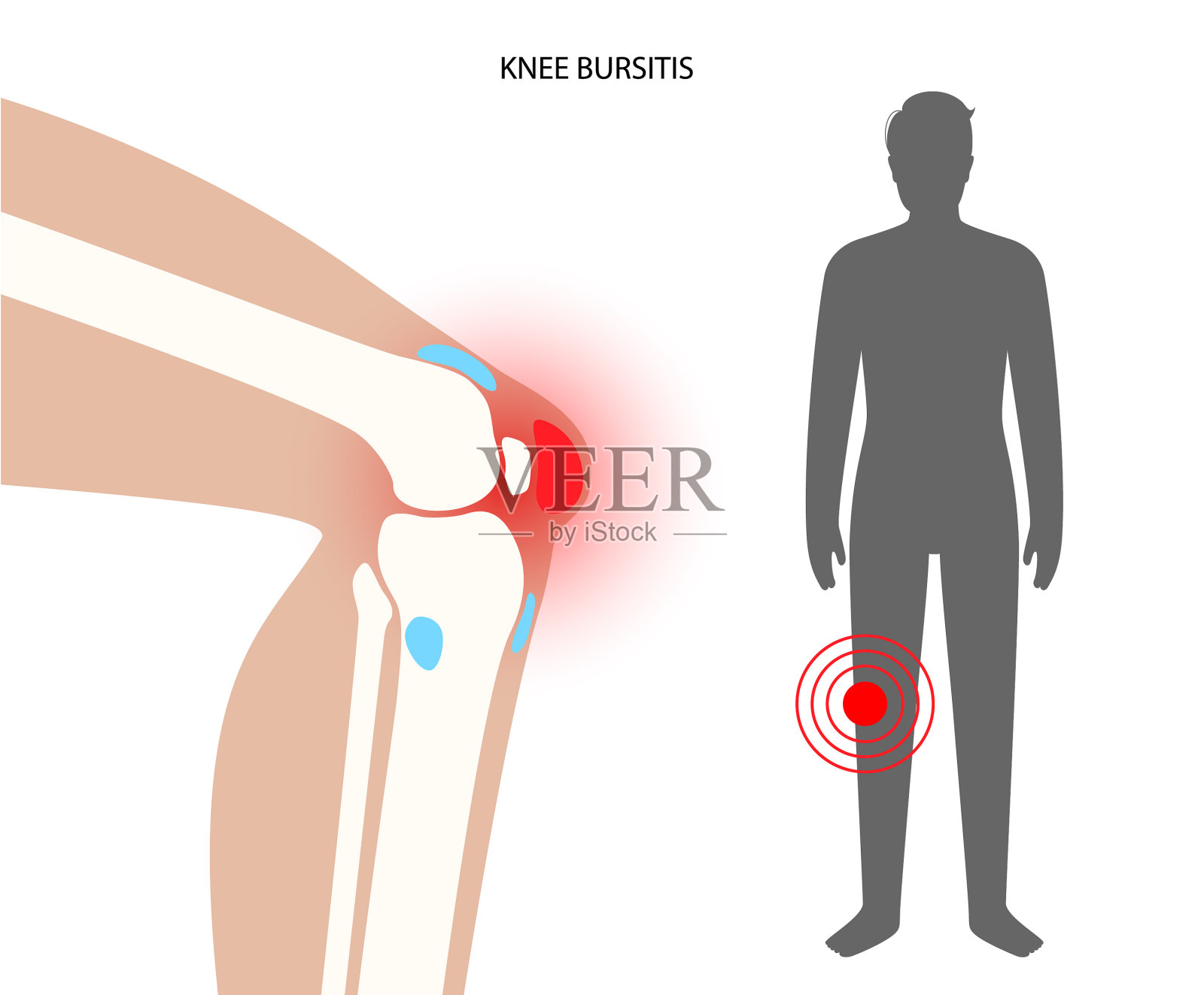 滑囊炎发炎的概念插画图片素材