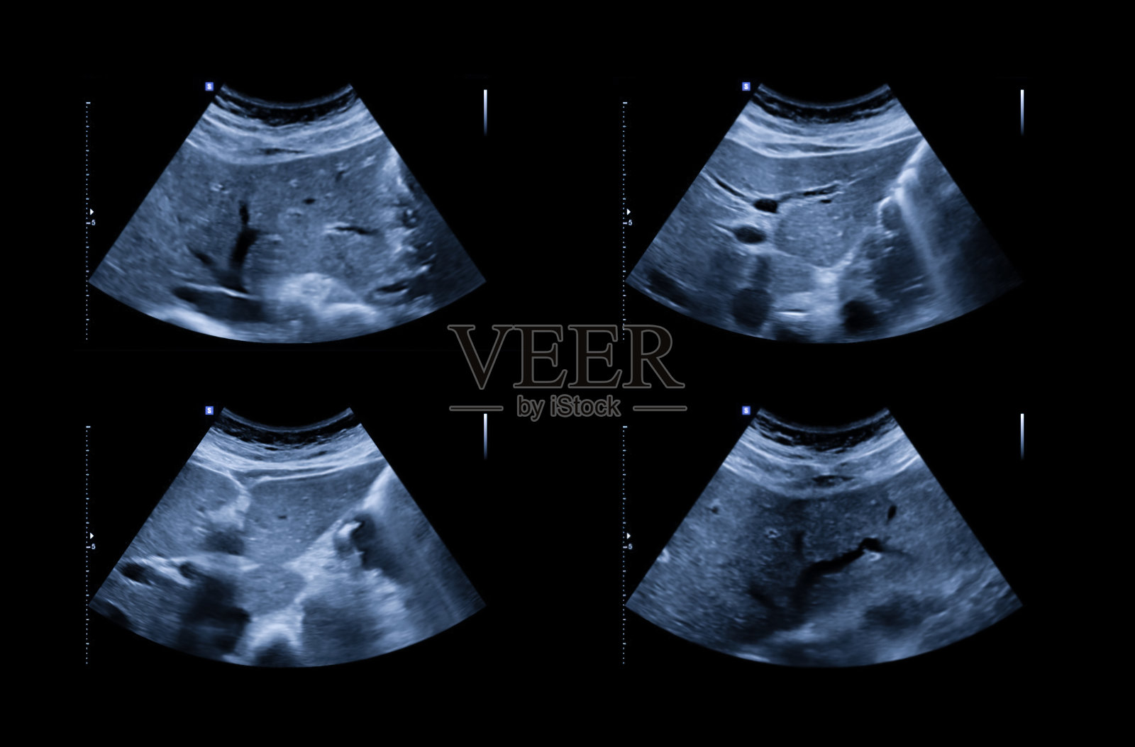 上腹部超声显示肝胆，用于筛选肝细胞癌和胆结石。照片摄影图片