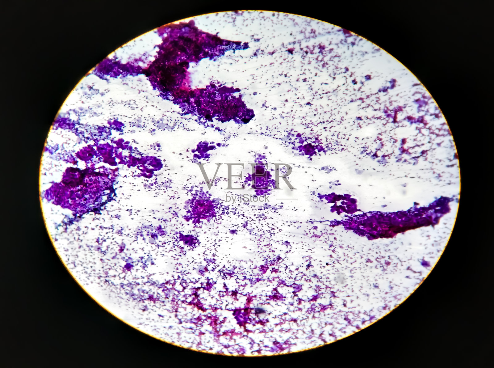 食管癌，FNAC载玻片100倍镜，显微镜下拍照照片摄影图片