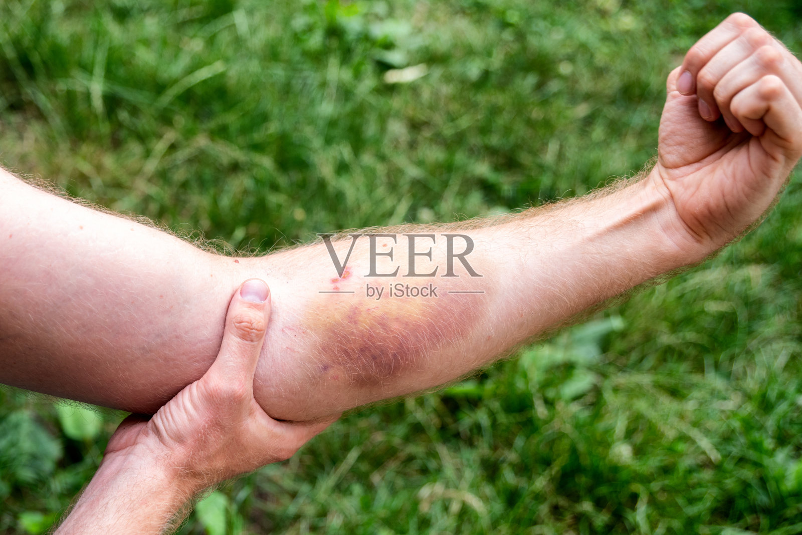 人的手臂上有大块瘀伤照片摄影图片