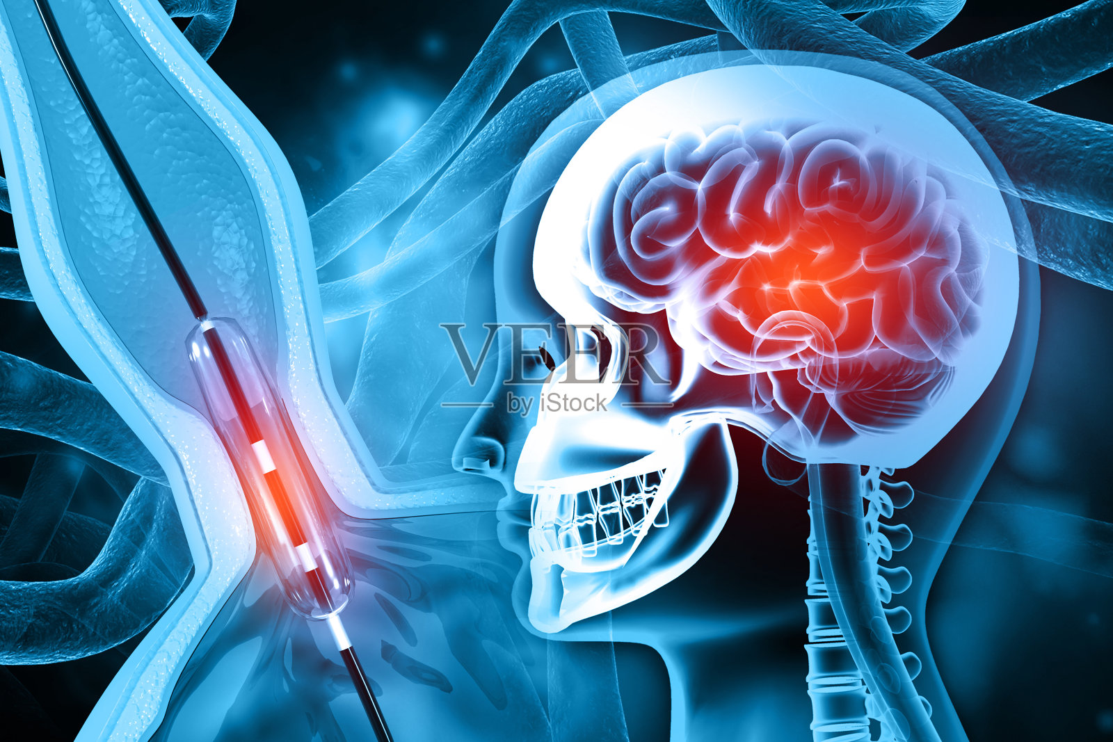 血管内支架球囊成形术。三维演示照片摄影图片