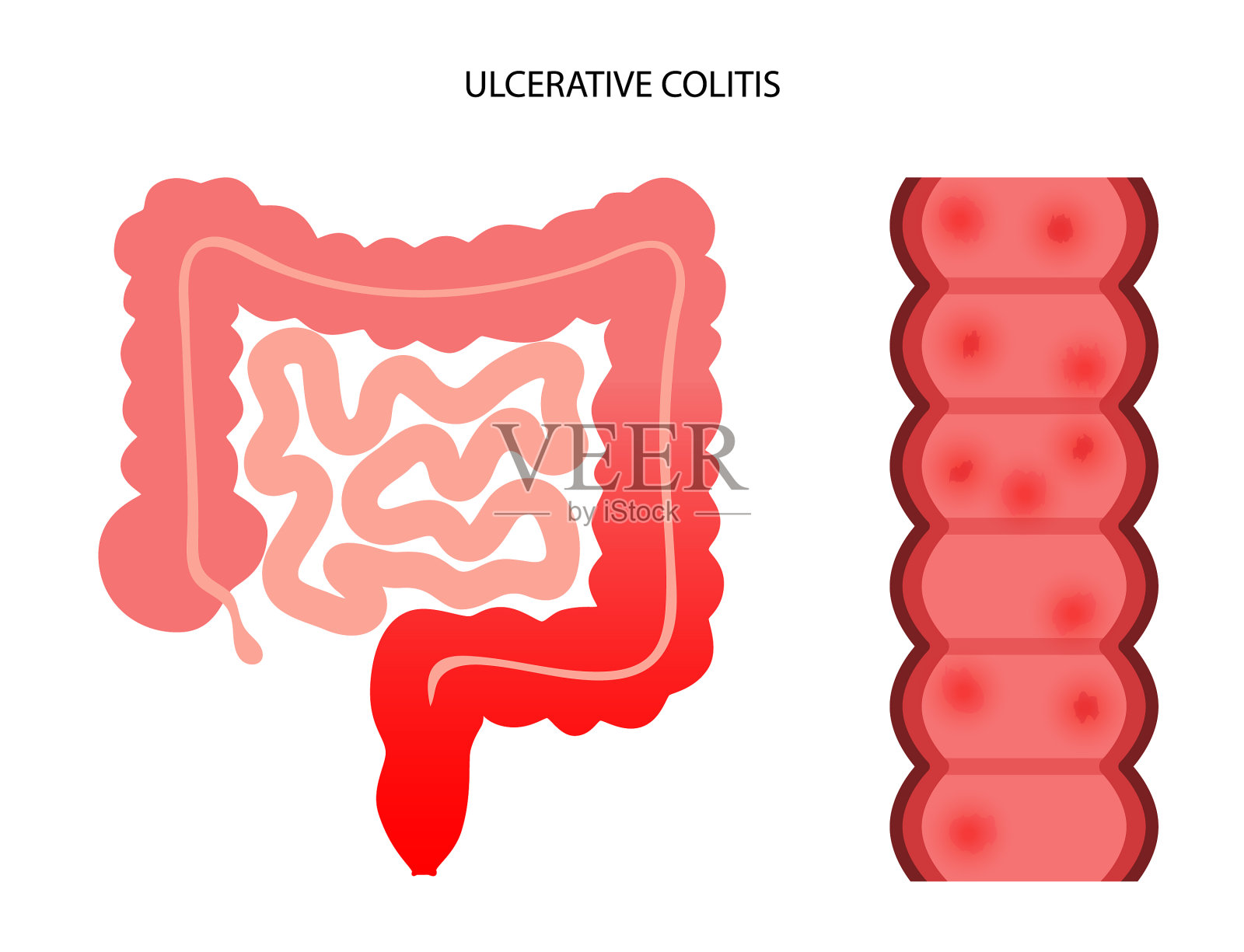 肠溃疡性结肠炎插画图片素材