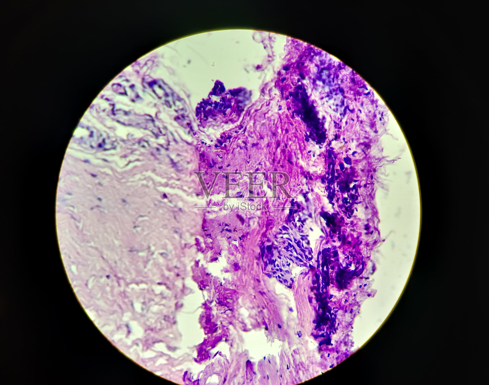 小叶毛细血管瘤，光镜下照片照片摄影图片