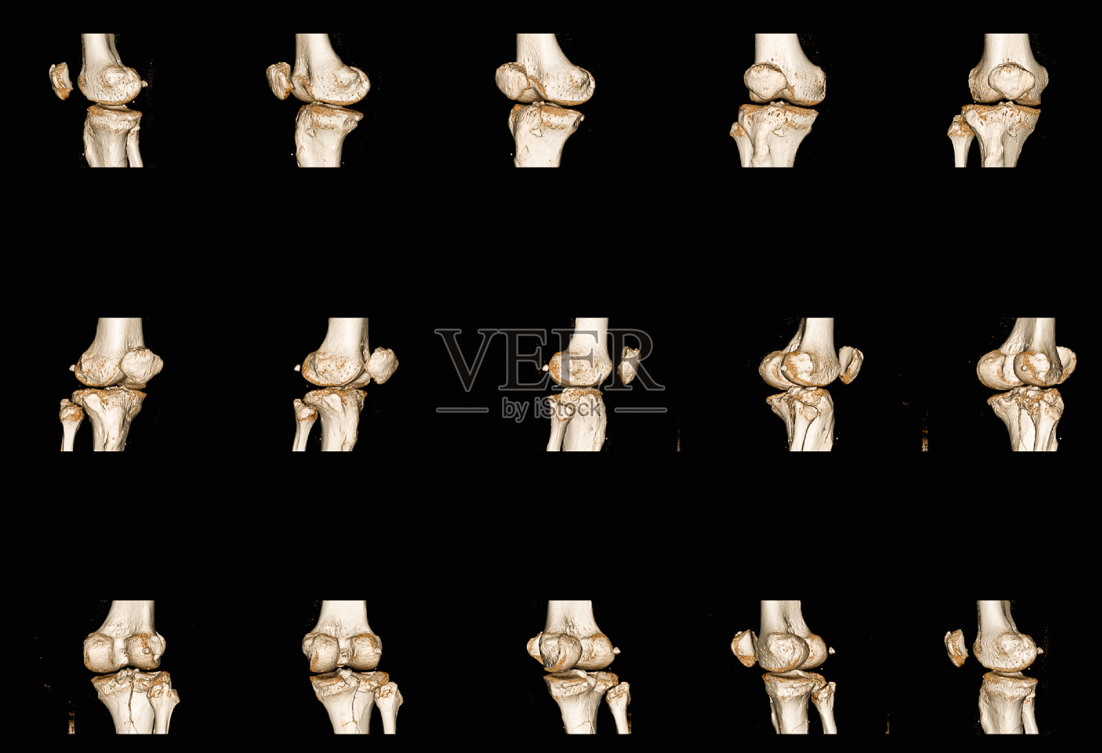 采集人膝关节x线片发现胫骨近端干骺端骨折。医疗和保险的概念。照片摄影图片