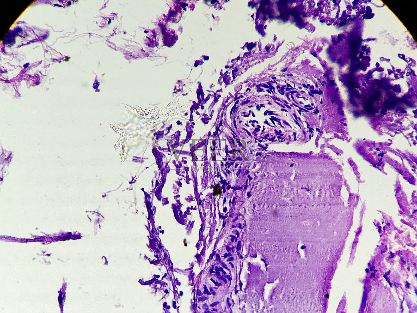 右踝关节囊性肿胀组织(切除0镜下100x显示神经节。照片摄影图片