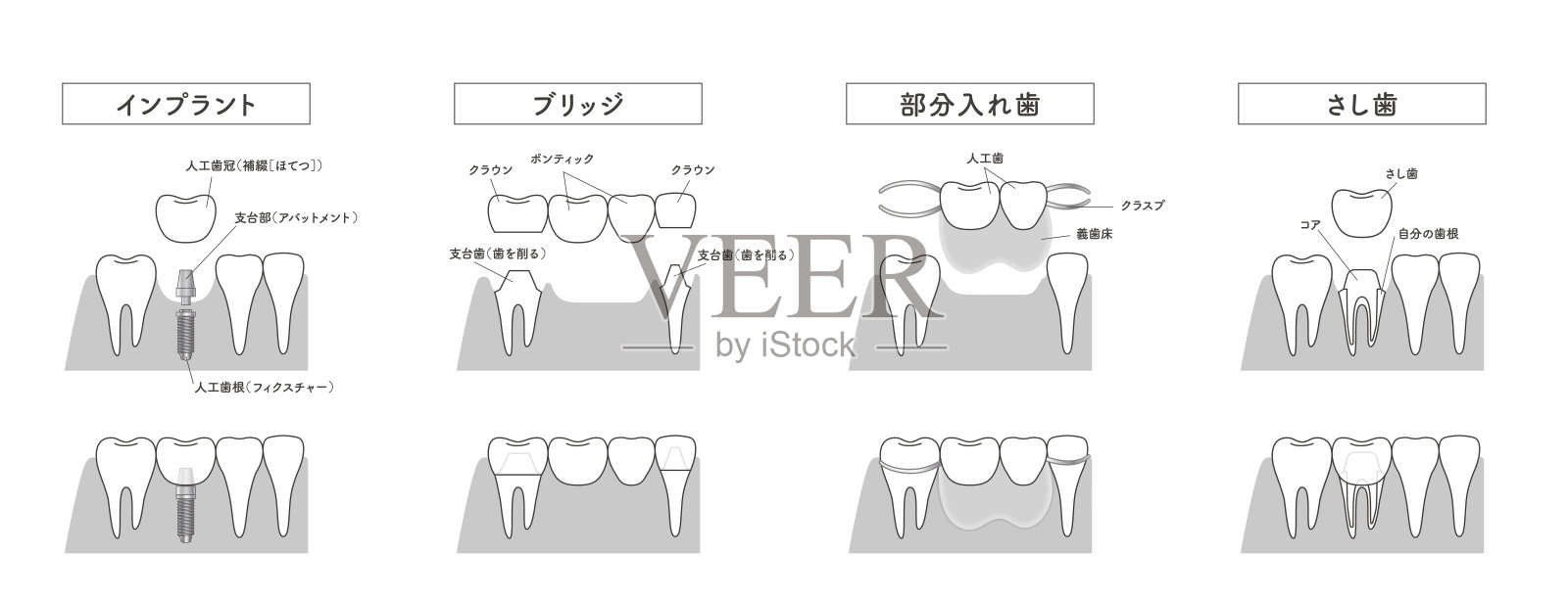 种植桥可摘局部义齿对比图插画图片素材