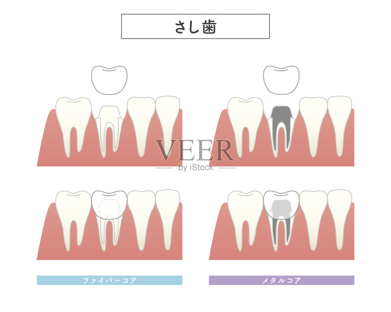 镶齿结构说明插画图片素材