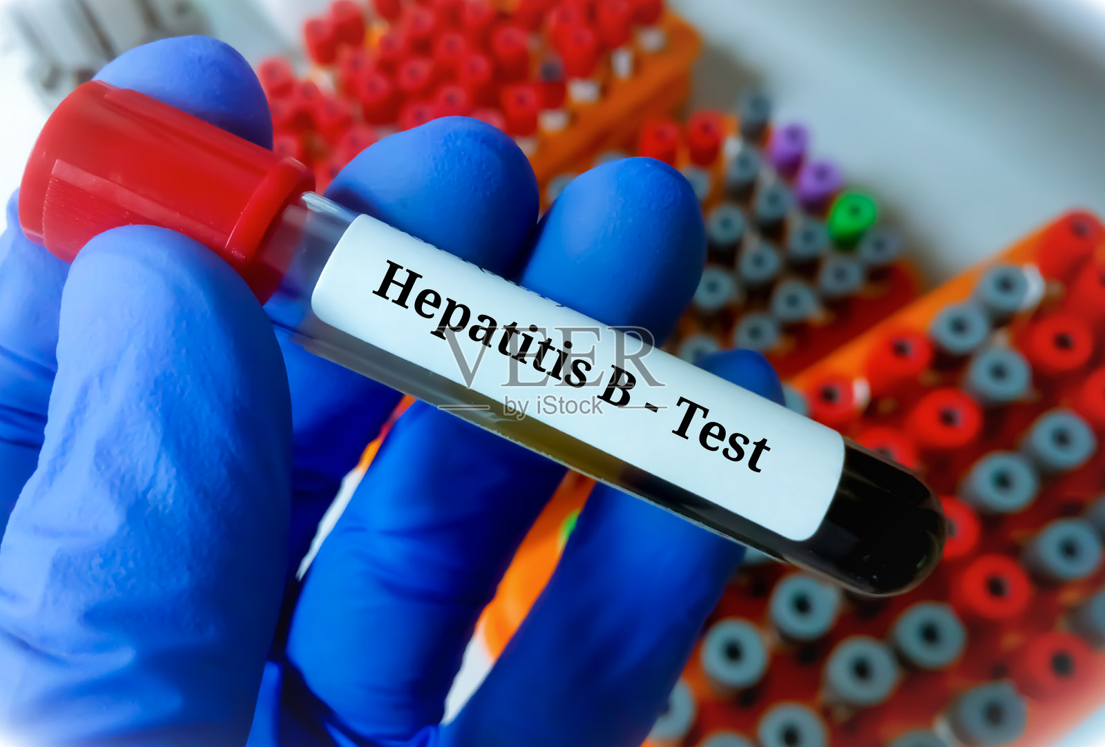 科学家手持乙型肝炎病毒化验血液样本照片摄影图片