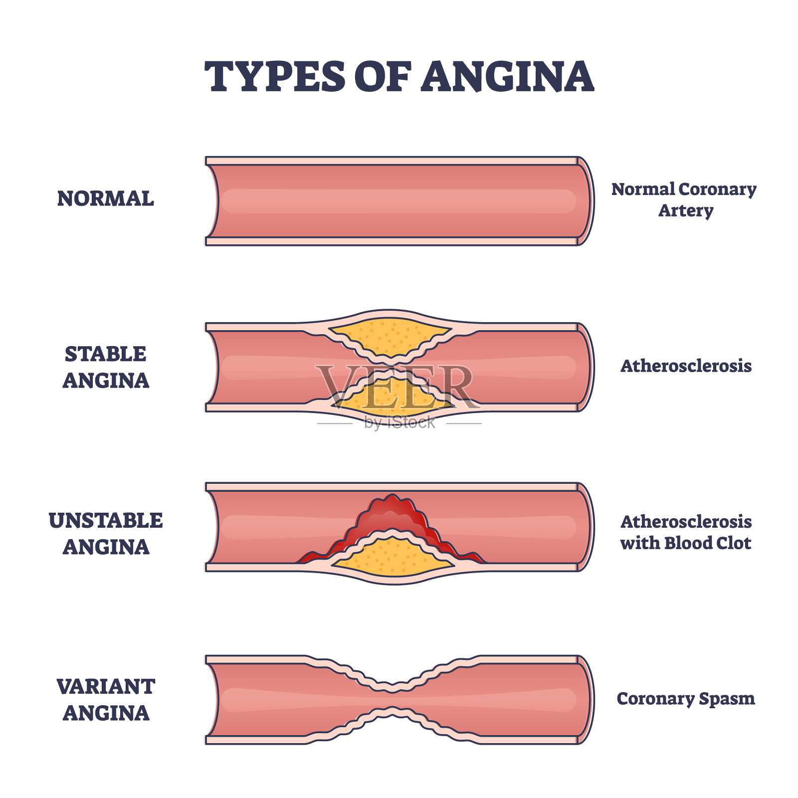 心绞痛的类型如胸痛和心脏问题解释概要图插画图片素材