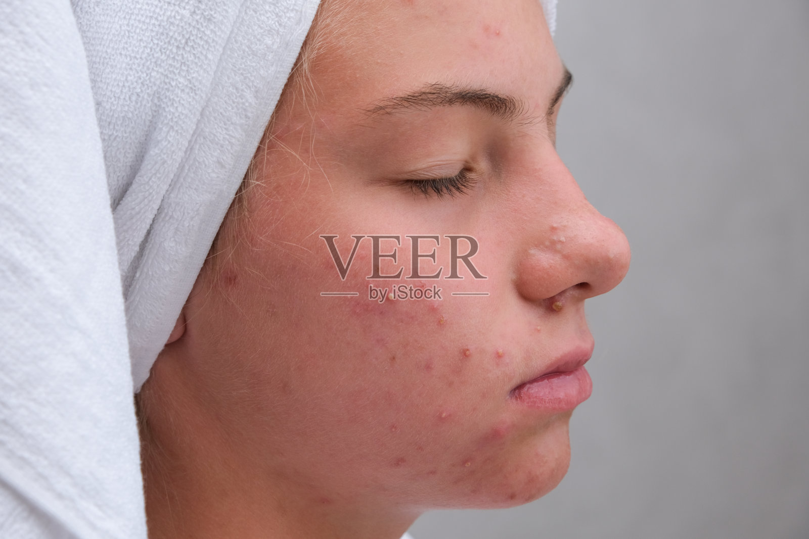 粉刺。脸上长着青春痘的少女。有问题的皮肤。特写镜头。照片摄影图片