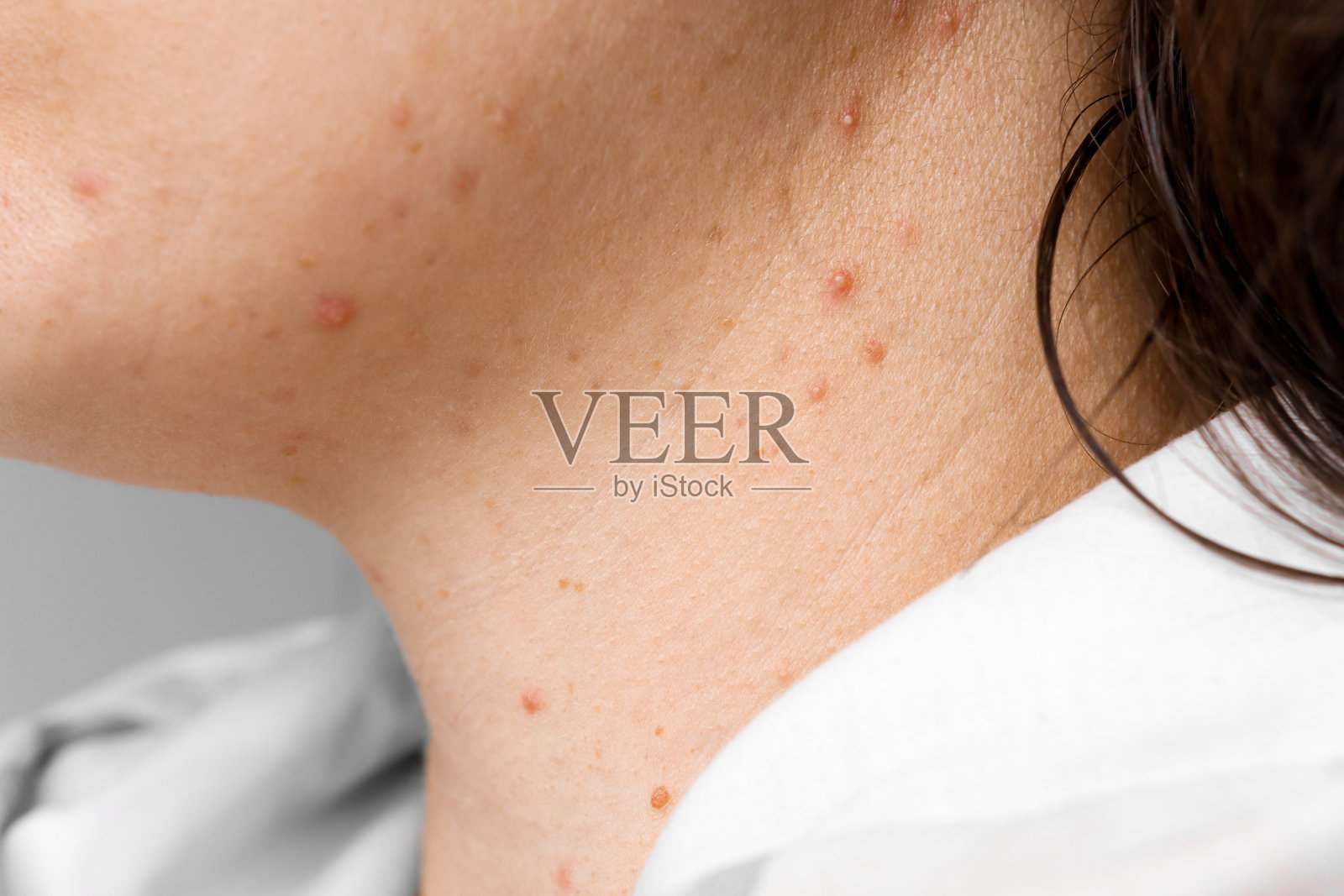 女人的脸和脖子与问题皮肤和丘疹特写。十几岁的红丘疹，护理与美容理念。照片摄影图片