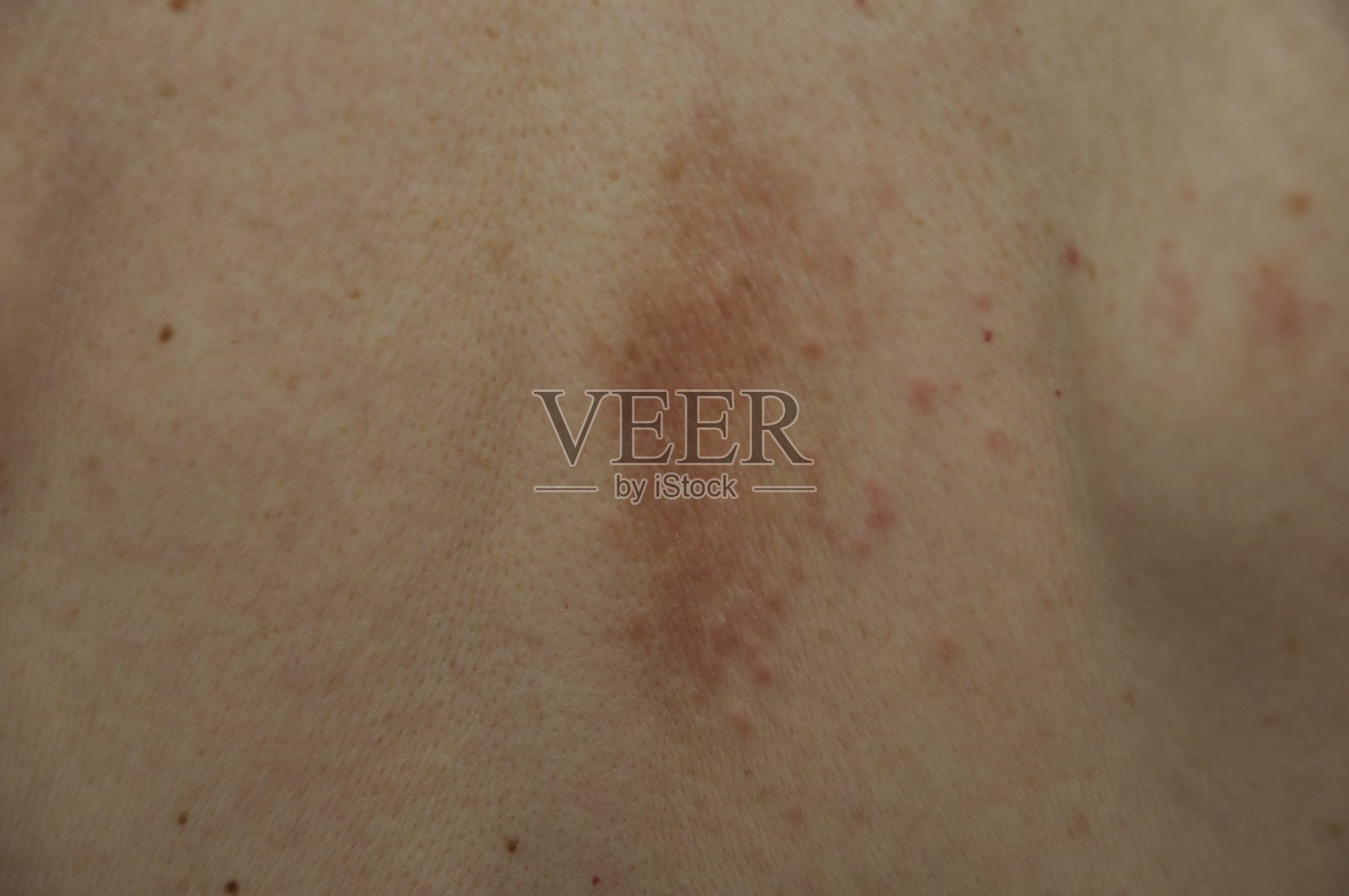 背上有湿疹丘疹照片摄影图片