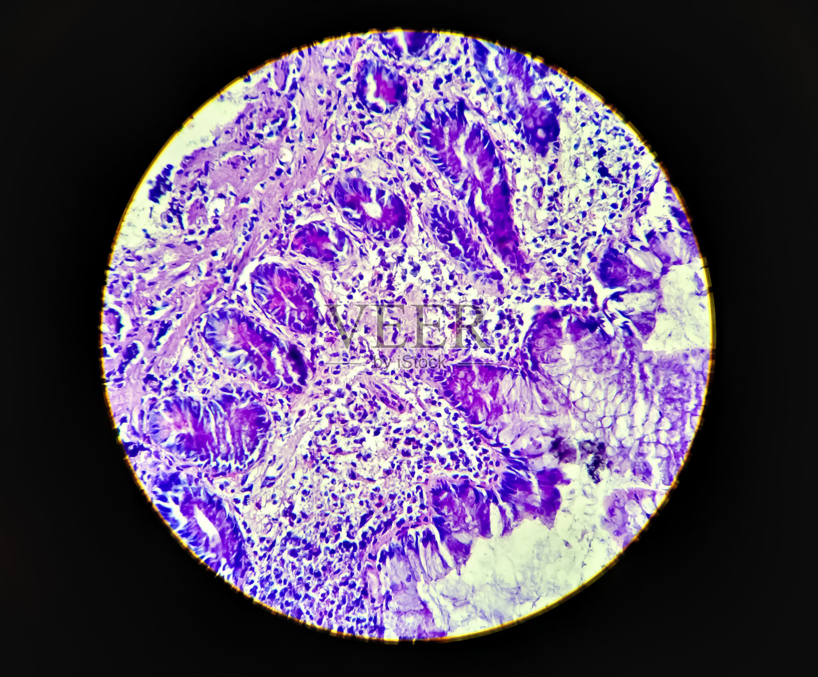 结肠癌:结肠腺癌的显微照片，光学显微镜200x显示结肠腺癌照片摄影图片