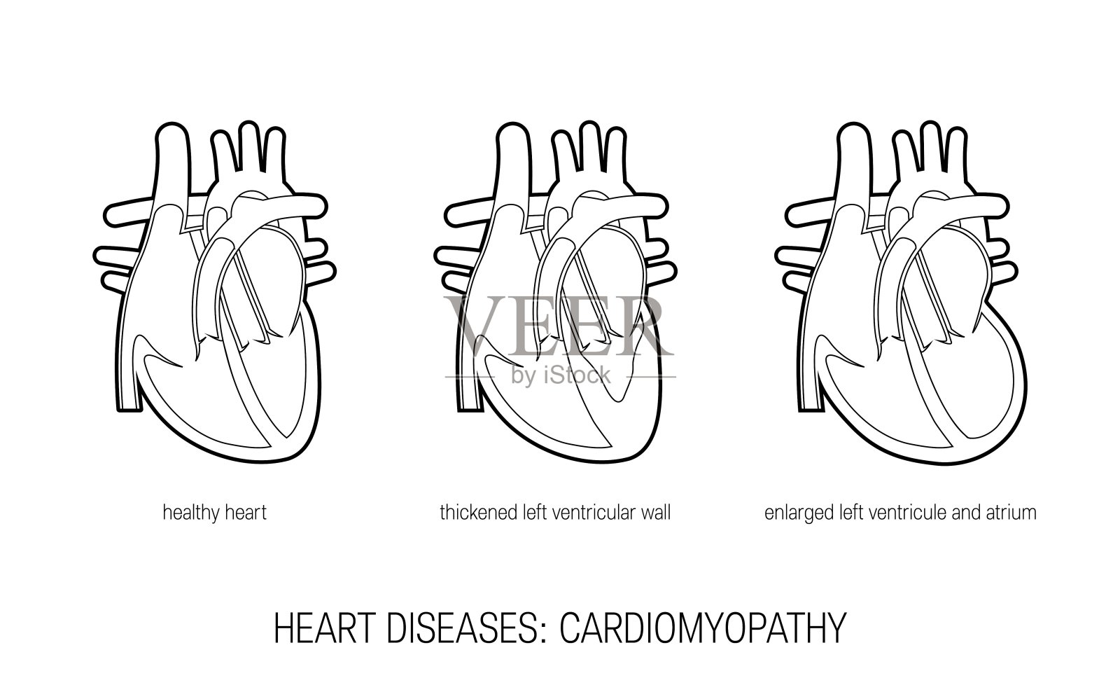 心脏病概念中平体，矢量插画图片素材