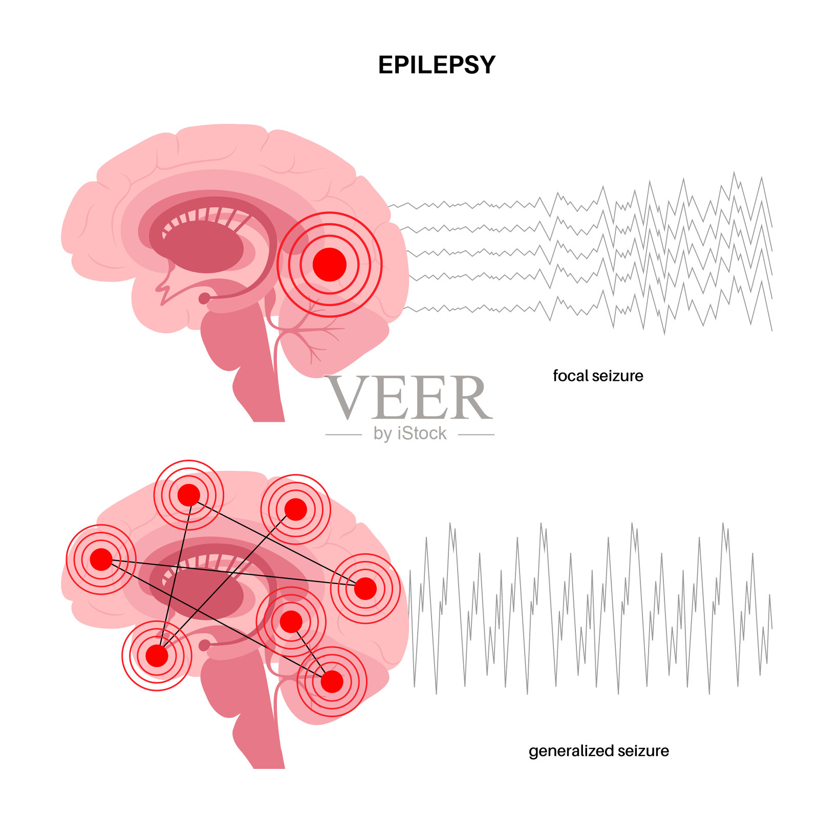 癫痫发作的概念插画图片素材