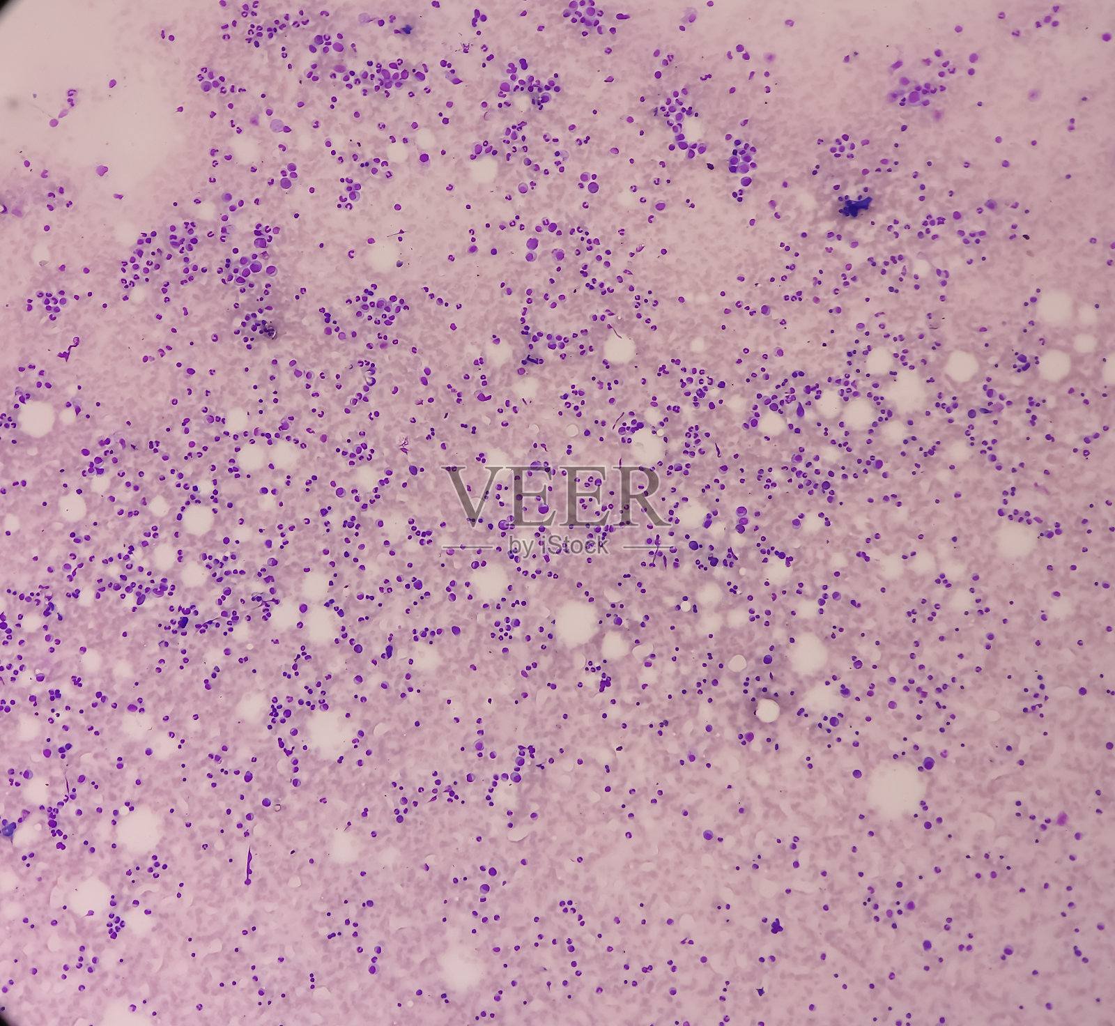 骨髓载玻片镜检，急性髓细胞白血病(AML)，成髓细胞异常。照片摄影图片