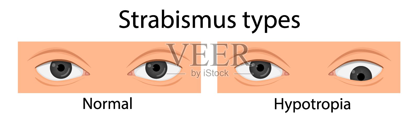类型的斜视。下斜视、上斜眼内斜视。卡通风格插画图片素材