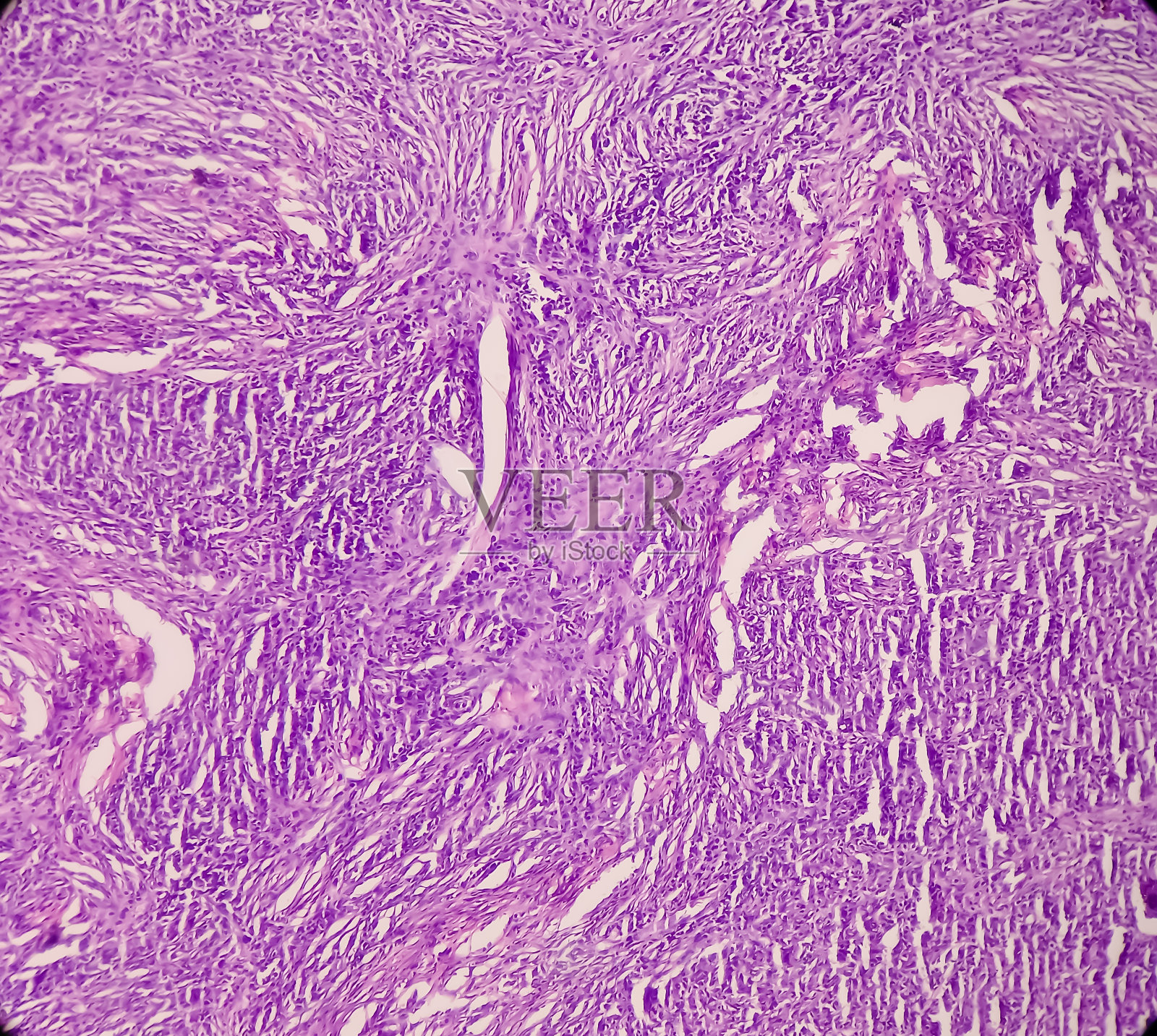 头皮组织:皮肤肿瘤，显微镜下皮肤纤维瘤，良性肿瘤，照片摄影图片
