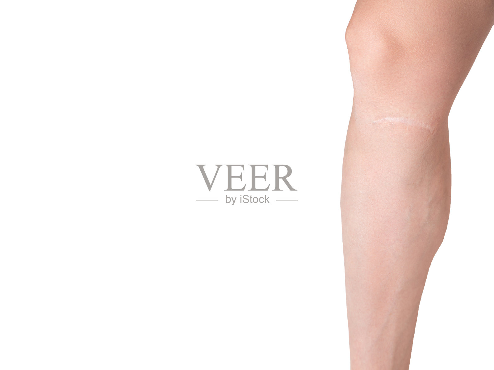 女孩腿上的伤疤特写。腿部受伤处的静脉曲张呈白色孤立背景照片摄影图片