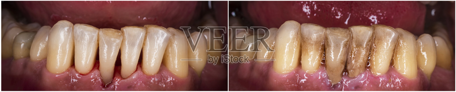 清洁及美白牙齿照片摄影图片