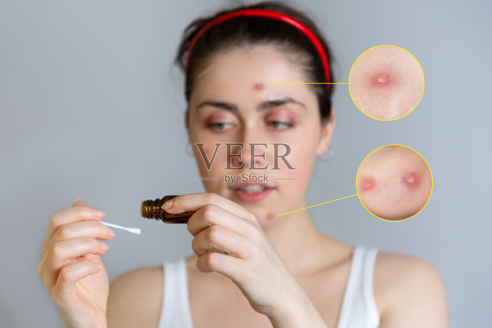 年轻美丽的女人与丘疹在她的脸上，拿着棉签和滴在她的痤疮药。放大的粉刺图片。青春痘、成长、美容的概念照片摄影图片