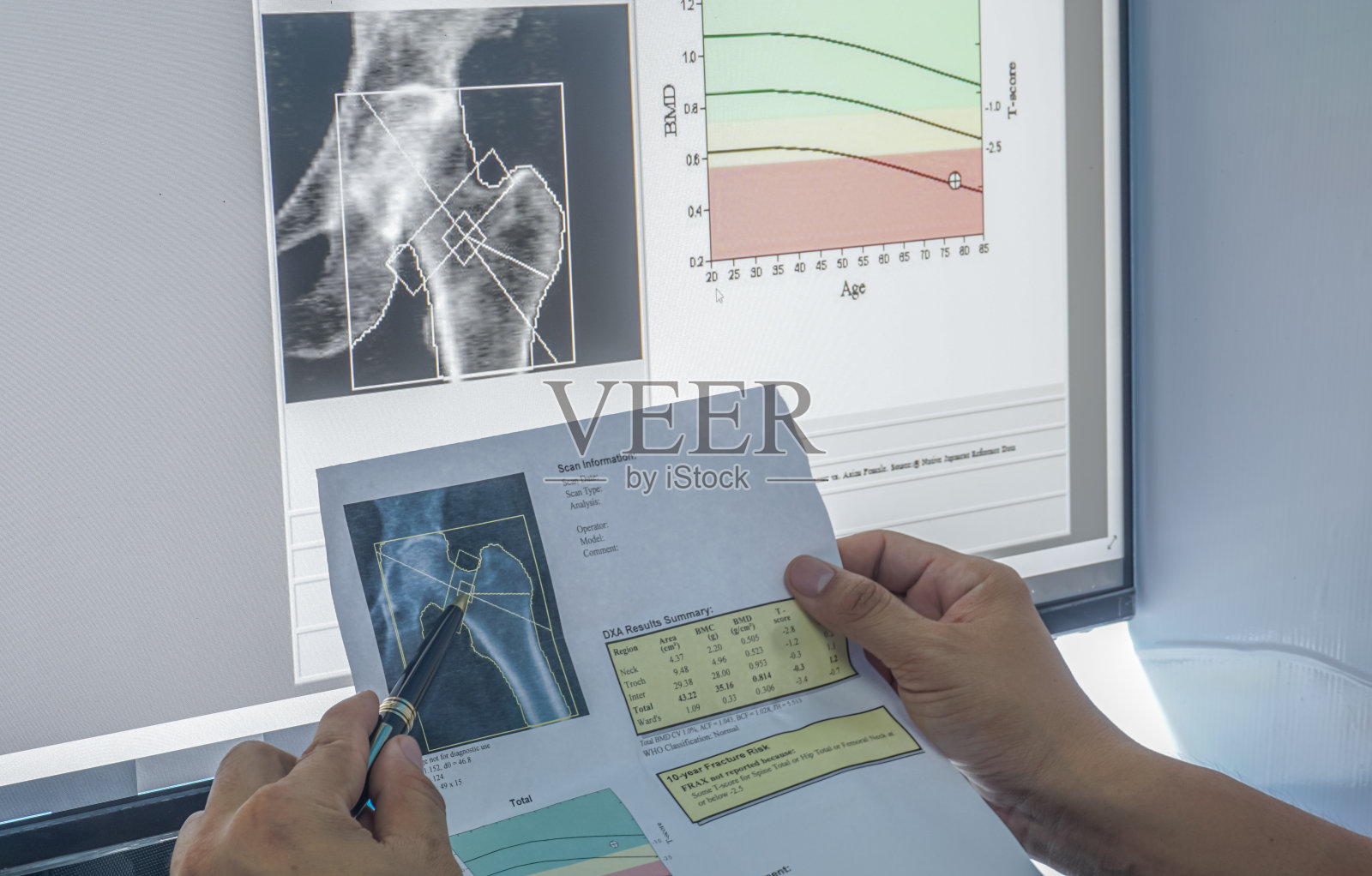 骨密度髋关节结果照片摄影图片