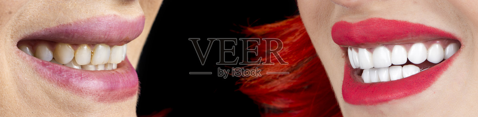 全口康复由冠饰面和种植体完成照片摄影图片