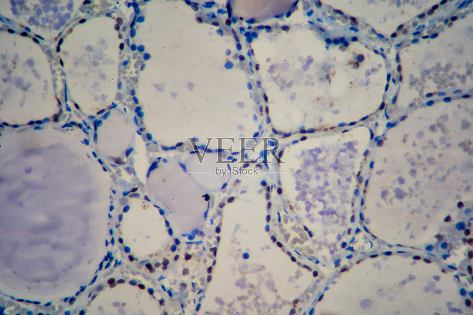 甲状腺的免疫组化TTF1。照片摄影图片