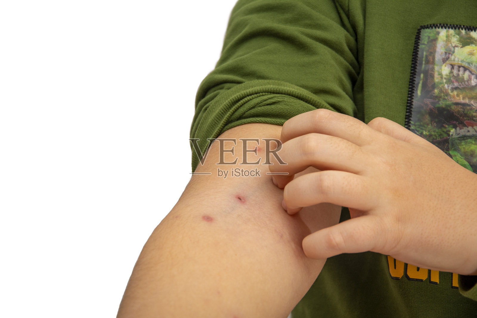 小孩用水痘抓他的胳膊的特写照片摄影图片