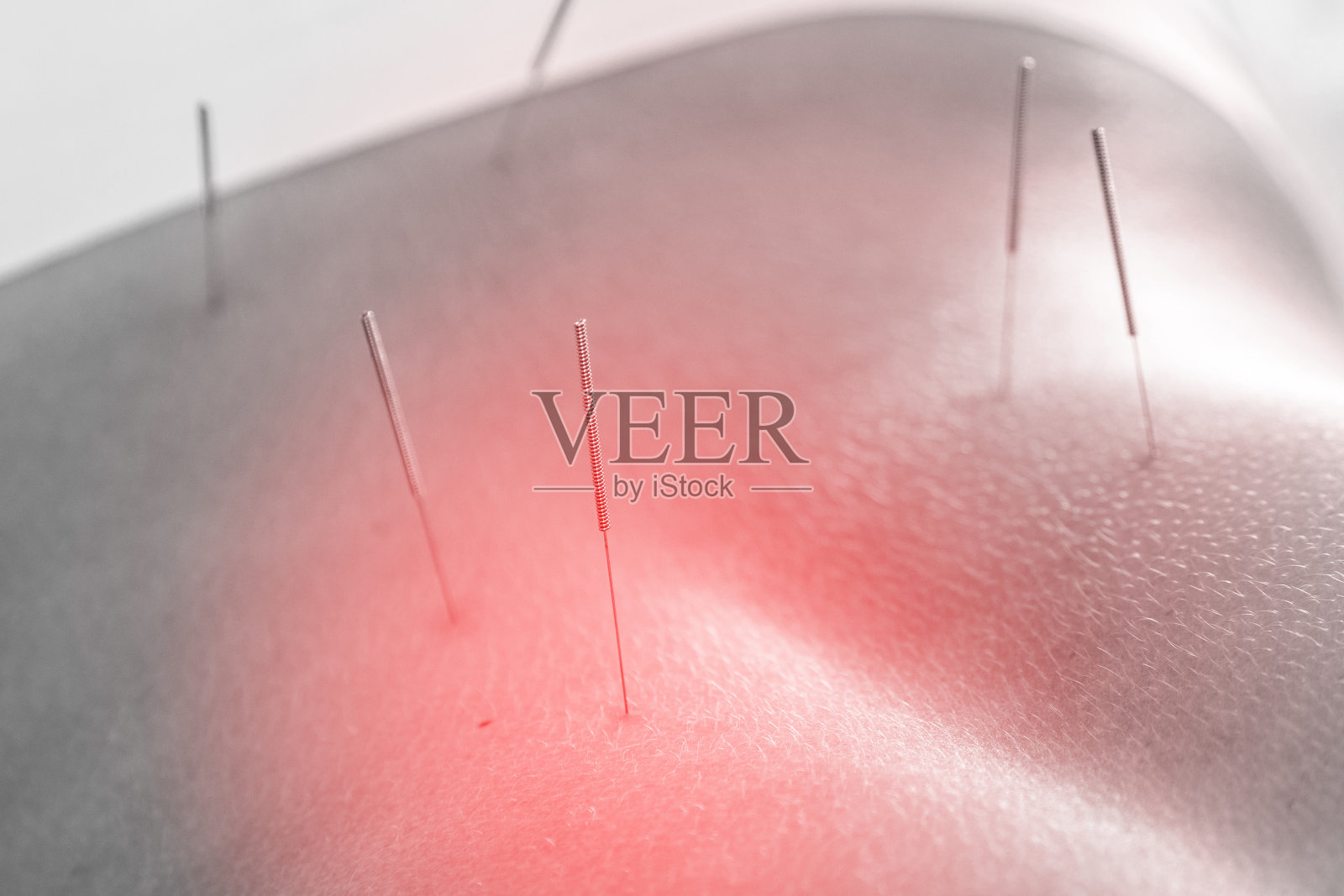 在针灸治疗过程中，女性身体与钢针插入的特写照片摄影图片