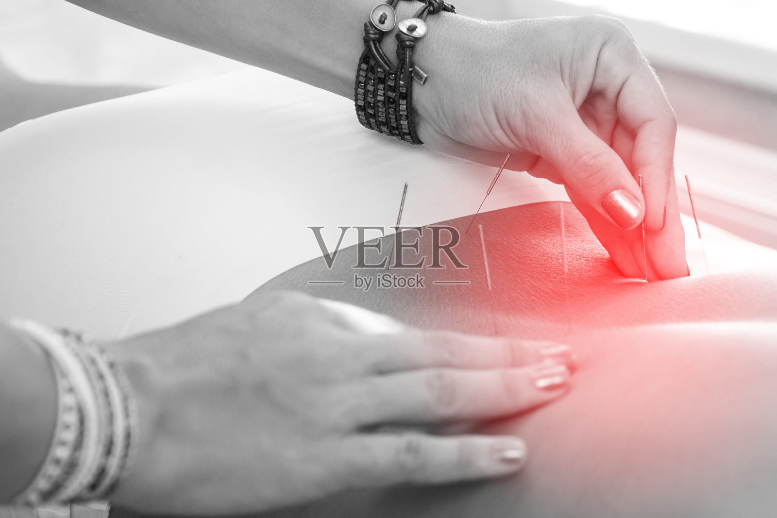 在针灸治疗过程中，女性身体与钢针插入的特写照片摄影图片