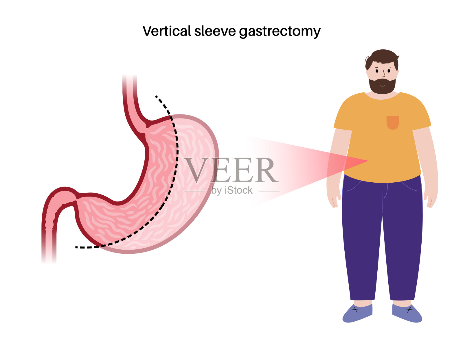 腹腔镜袖胃切除术插画图片素材