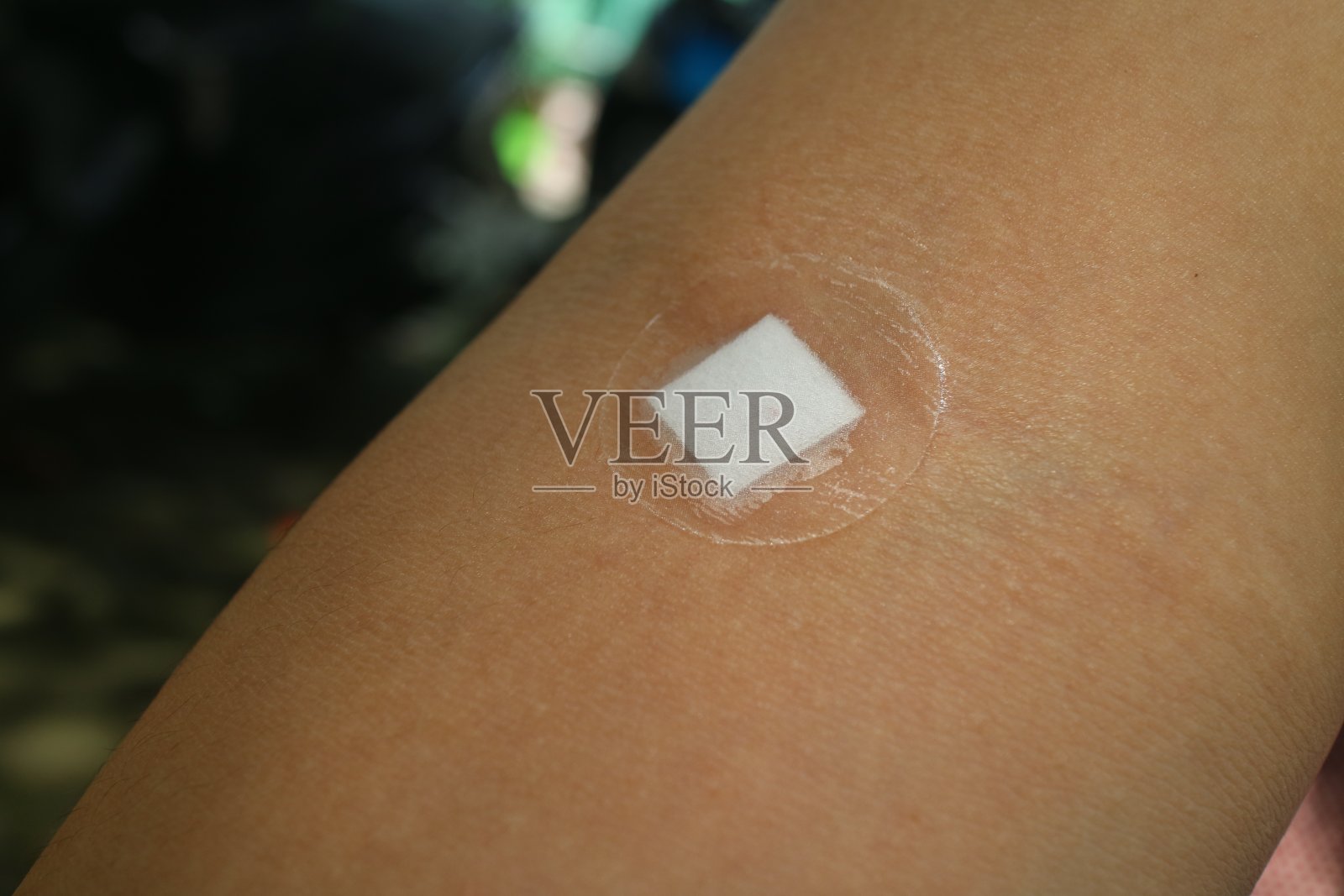 手部注射石膏罩照片摄影图片