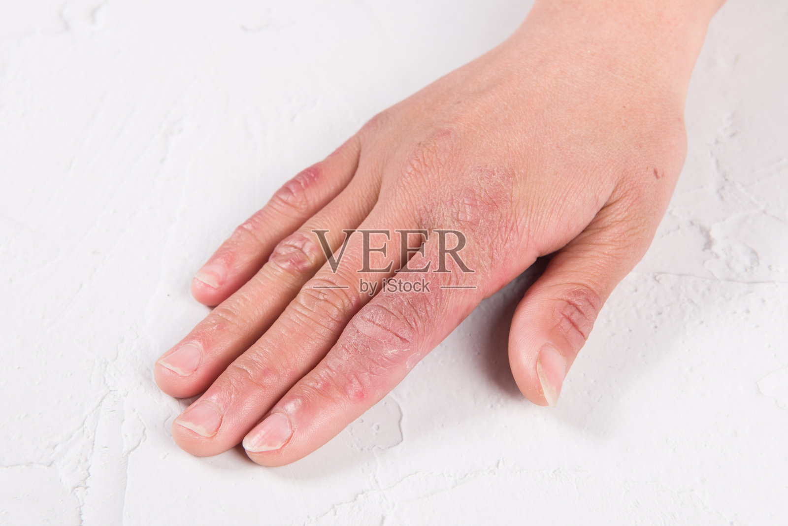 桌子上有冻疮的女性手特写照片摄影图片