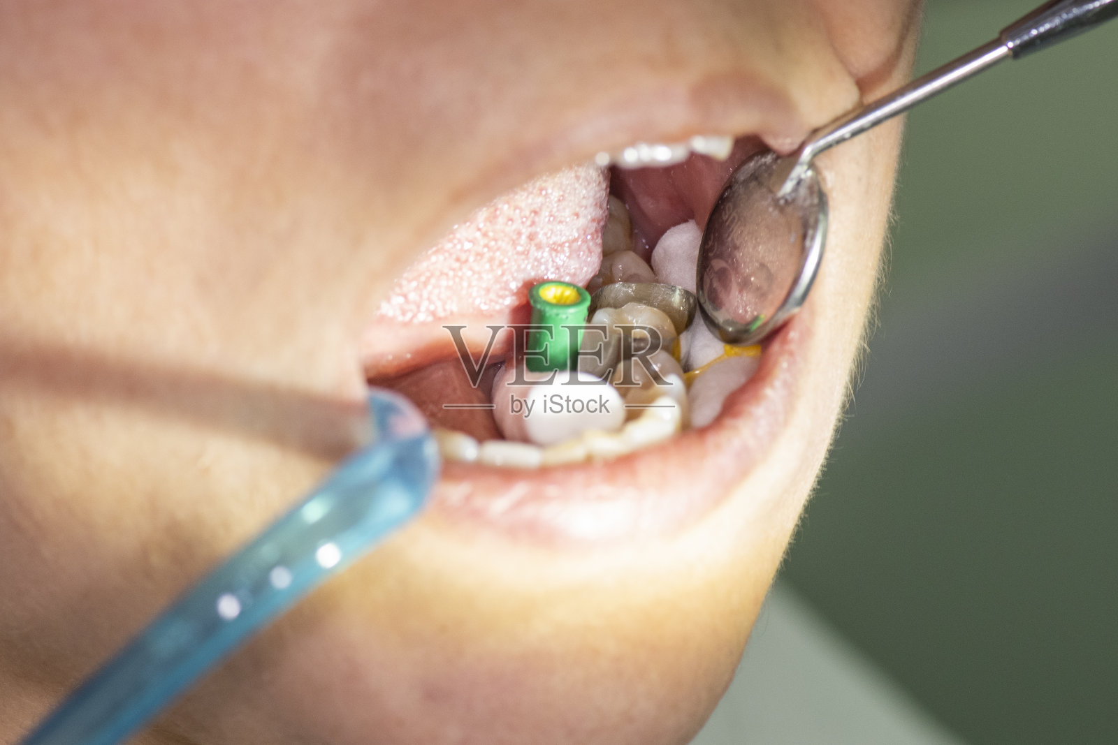 年轻女性进行牙科检查和牙科手术照片摄影图片