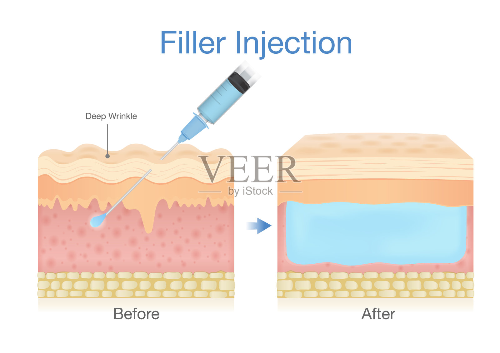 美容手术用针将填充物注射到皮肤层。说明皮肤治疗减少皱纹的效果。插画图片素材