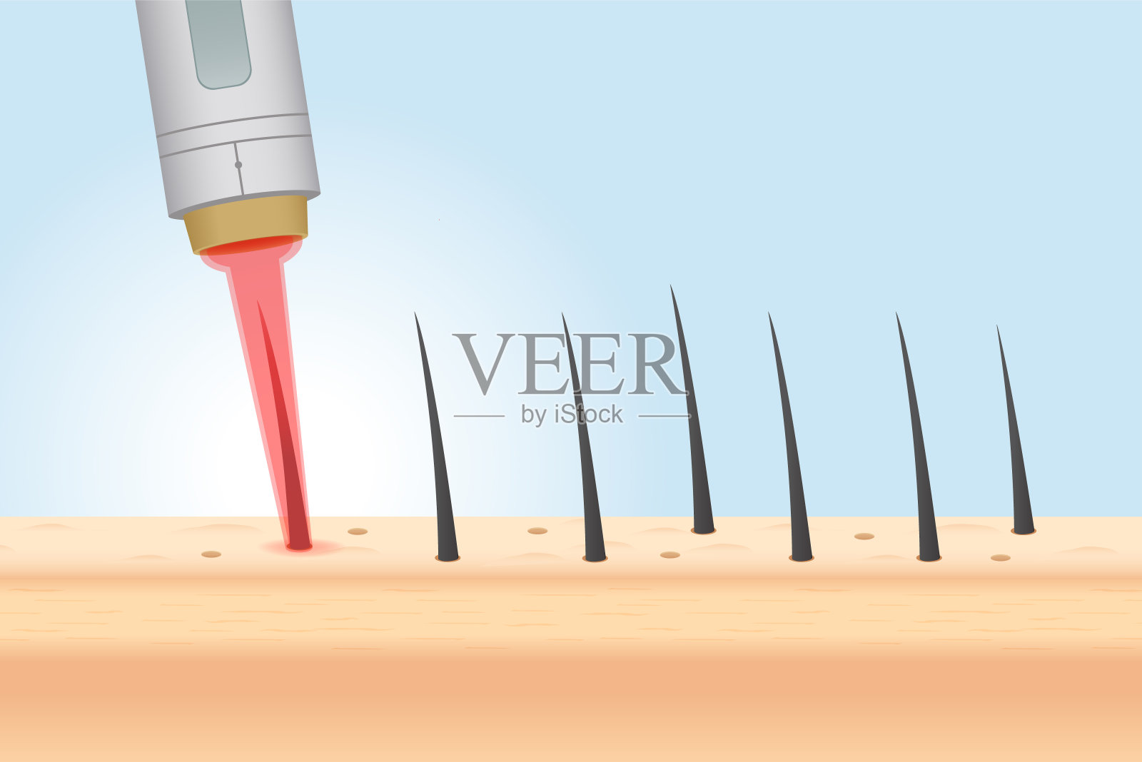 激光脱毛在皮肤层和毛囊的美丽和光滑。关于身体脱毛与IPL的说明。插画图片素材