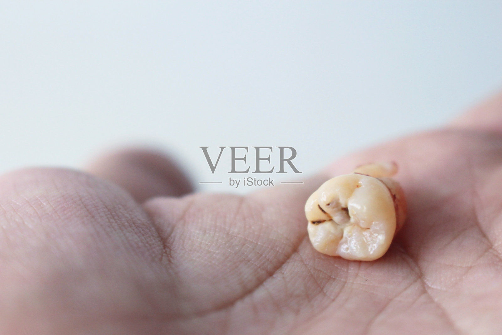 已经拔掉的蛀牙。照片摄影图片