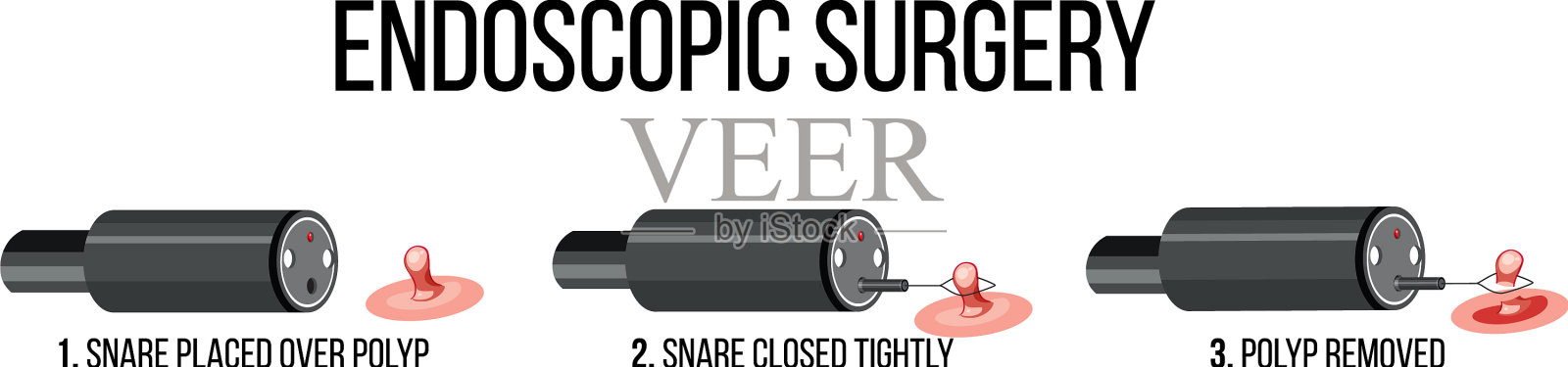 内窥镜手术示意图插画图片素材