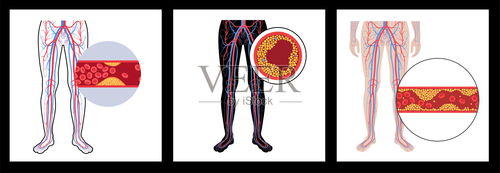 外周动脉疾病插画图片素材