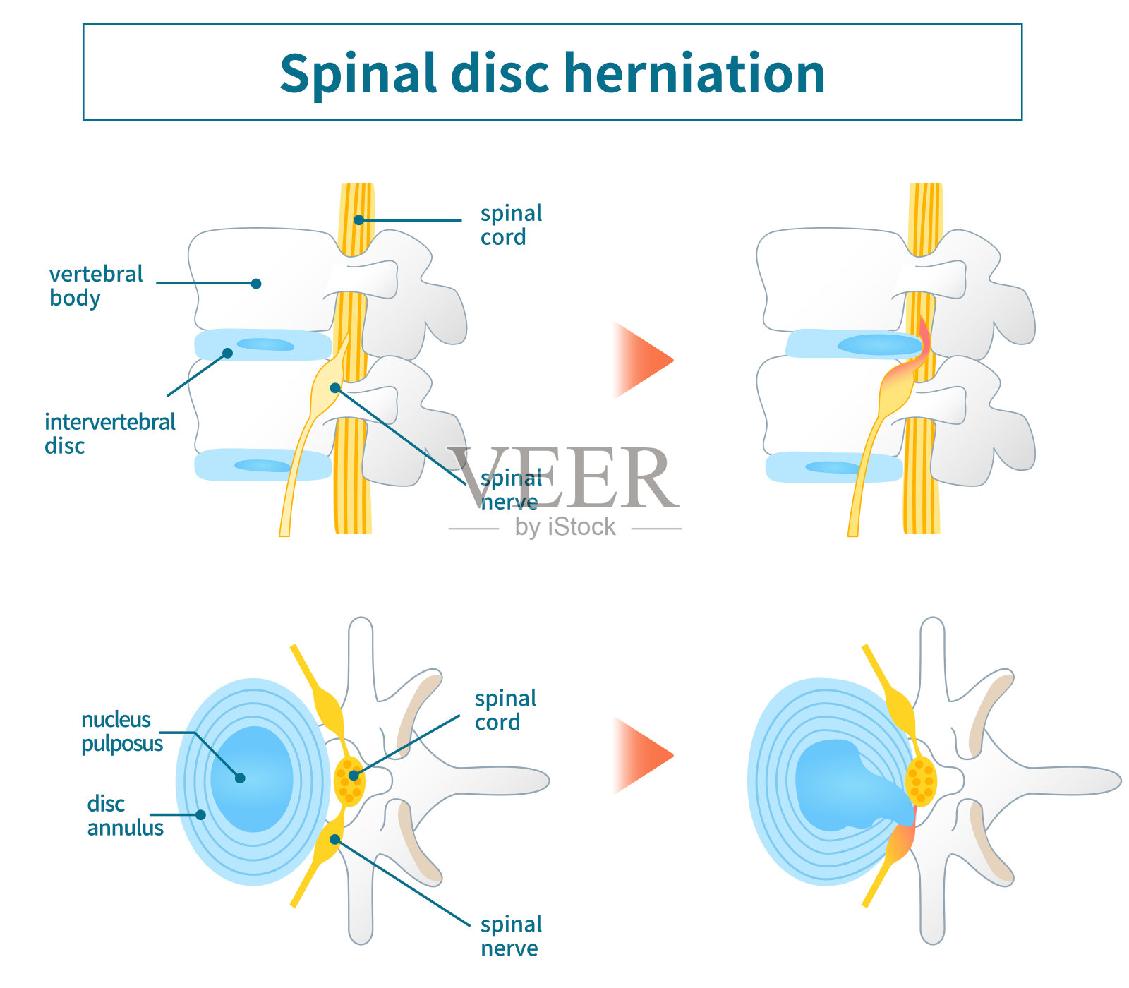 腰椎间盘突出症图示插画图片素材