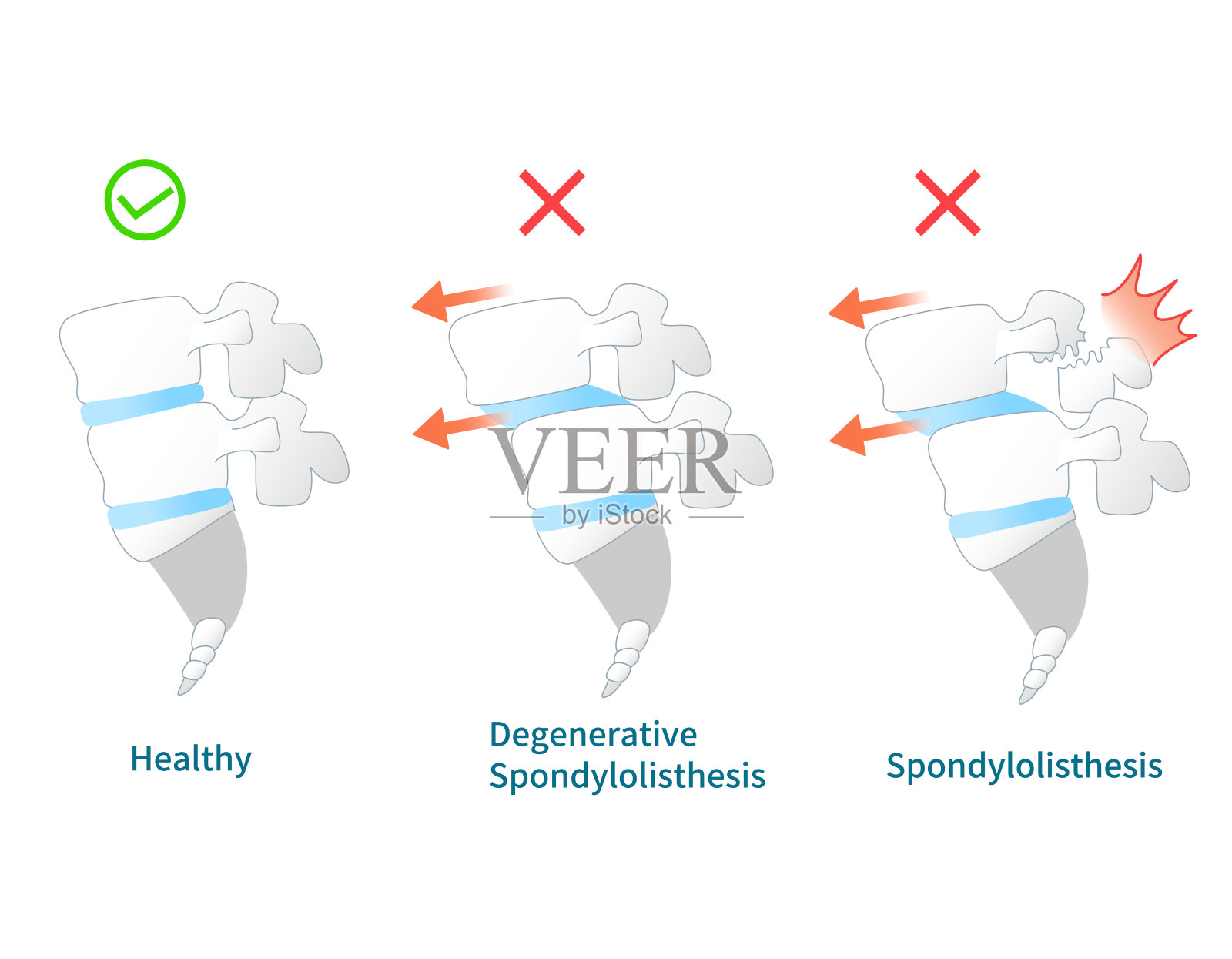 脊椎滑脱症状的说明插画图片素材