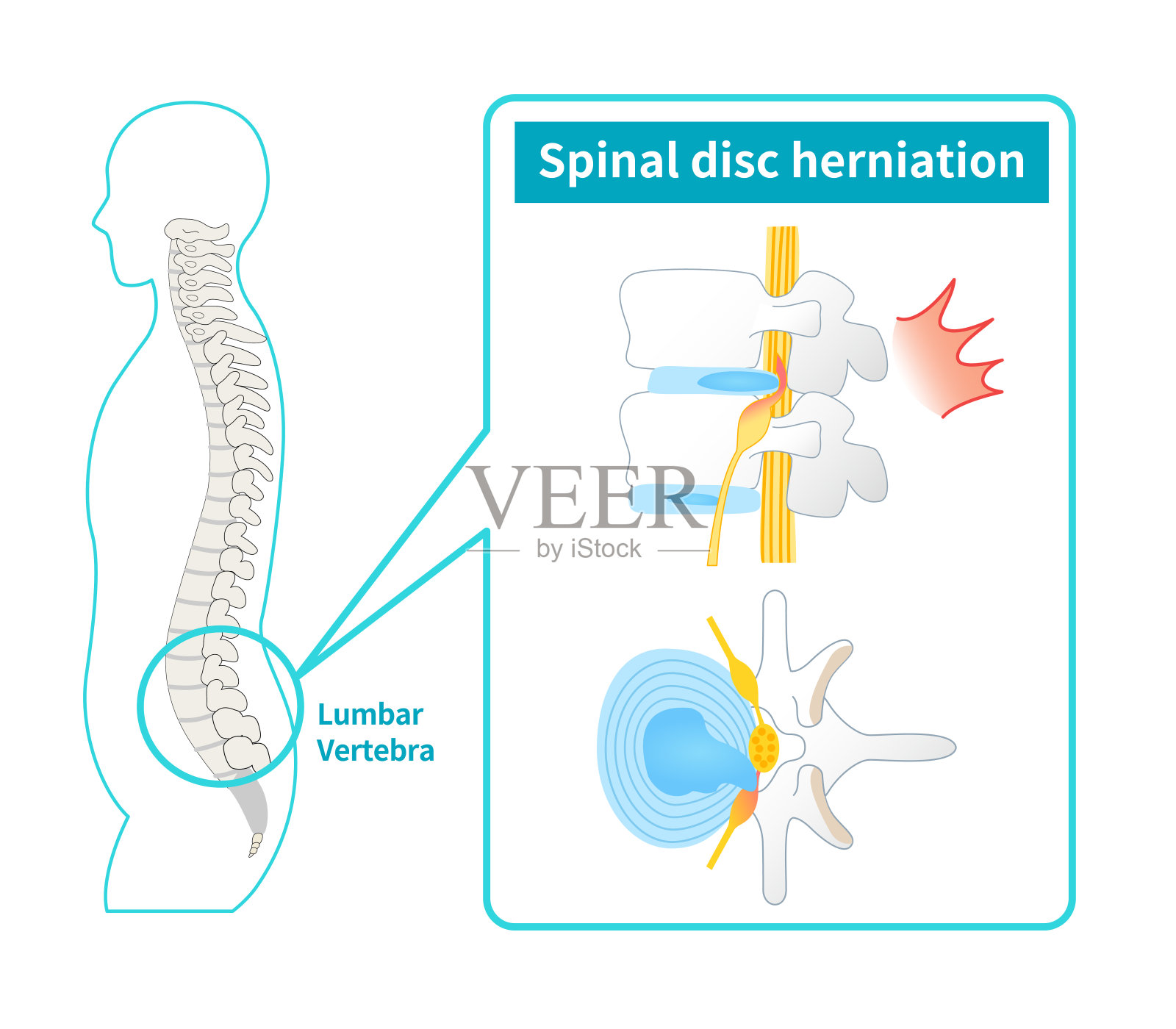 腰椎间盘突出症图示插画图片素材