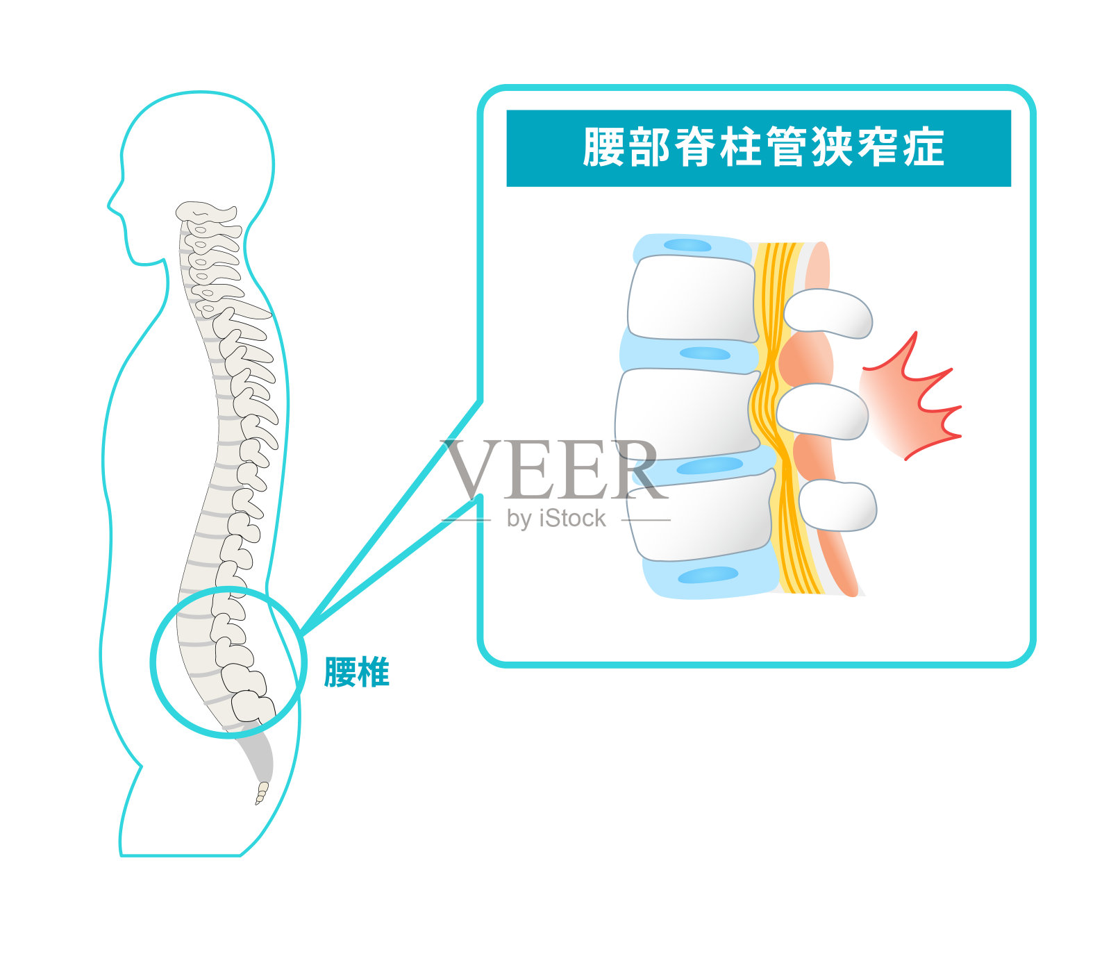 腰椎管狭窄图示插画图片素材
